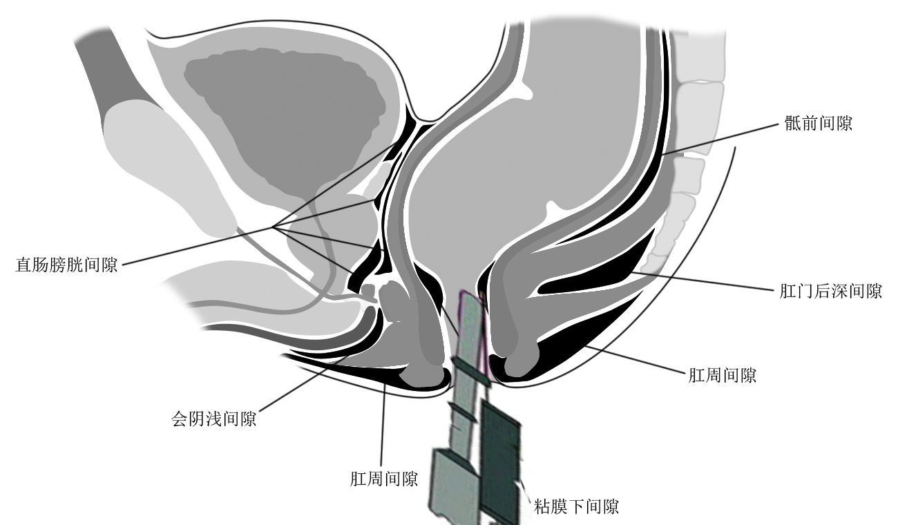 肛周脓肿.jpg 肛周脓肿.jpg