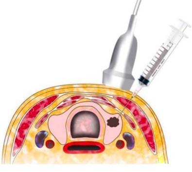 甲状腺结节B超1.jpg 甲状腺结节B超1.jpg