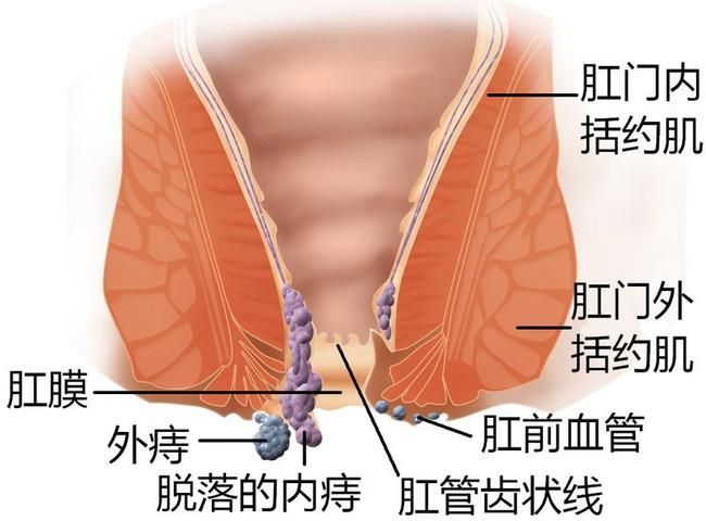痔疮1.jpg 痔疮1.jpg