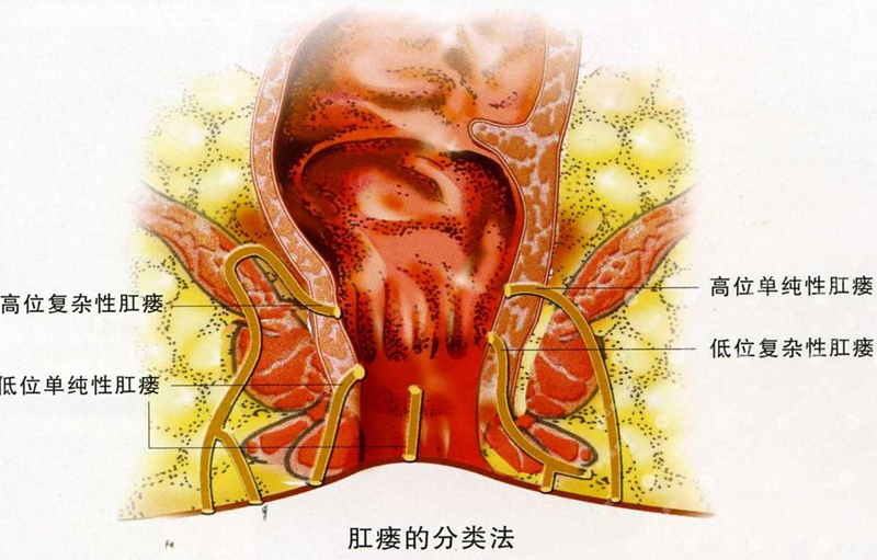 括约肌间瘘管结扎术(LIFT).png 括约肌间瘘管结扎术(LIFT).png