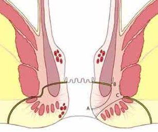 括约肌间瘘管结扎术(LIFT)1.jpg 括约肌间瘘管结扎术(LIFT)1.jpg