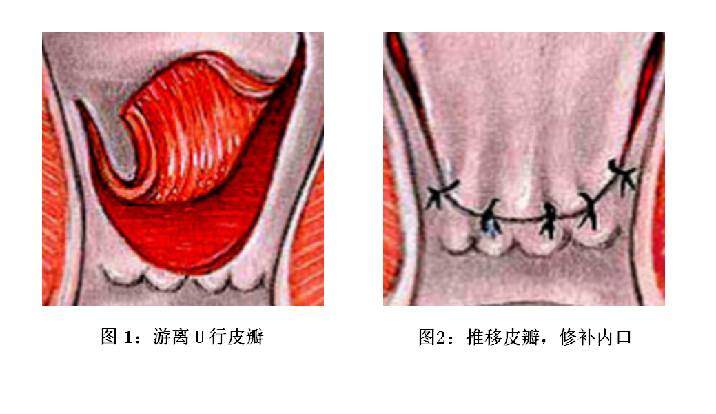 直肠粘膜瓣推移术.jpg 直肠粘膜瓣推移术.jpg