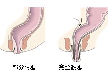 直肠脱垂.jpg 直肠脱垂.jpg