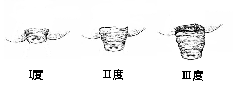 1直肠脱垂.jpg 1直肠脱垂.jpg