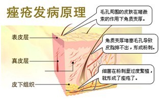 痤疮科普.jpg 痤疮科普.jpg