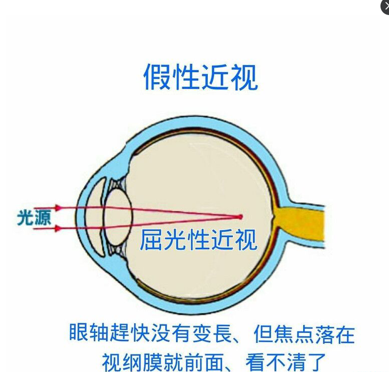 假性近视2.png 假性近视2.png